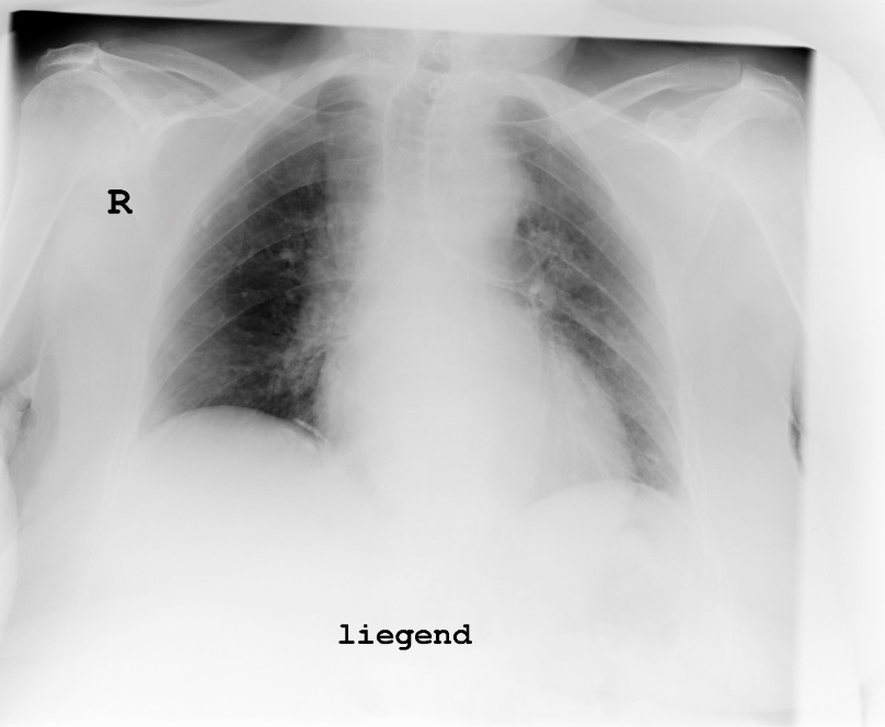 Röntgen Thorax liegend